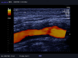 Ultrazvok vratnih žil - maščobno fibrozni plak v notranji karotidi